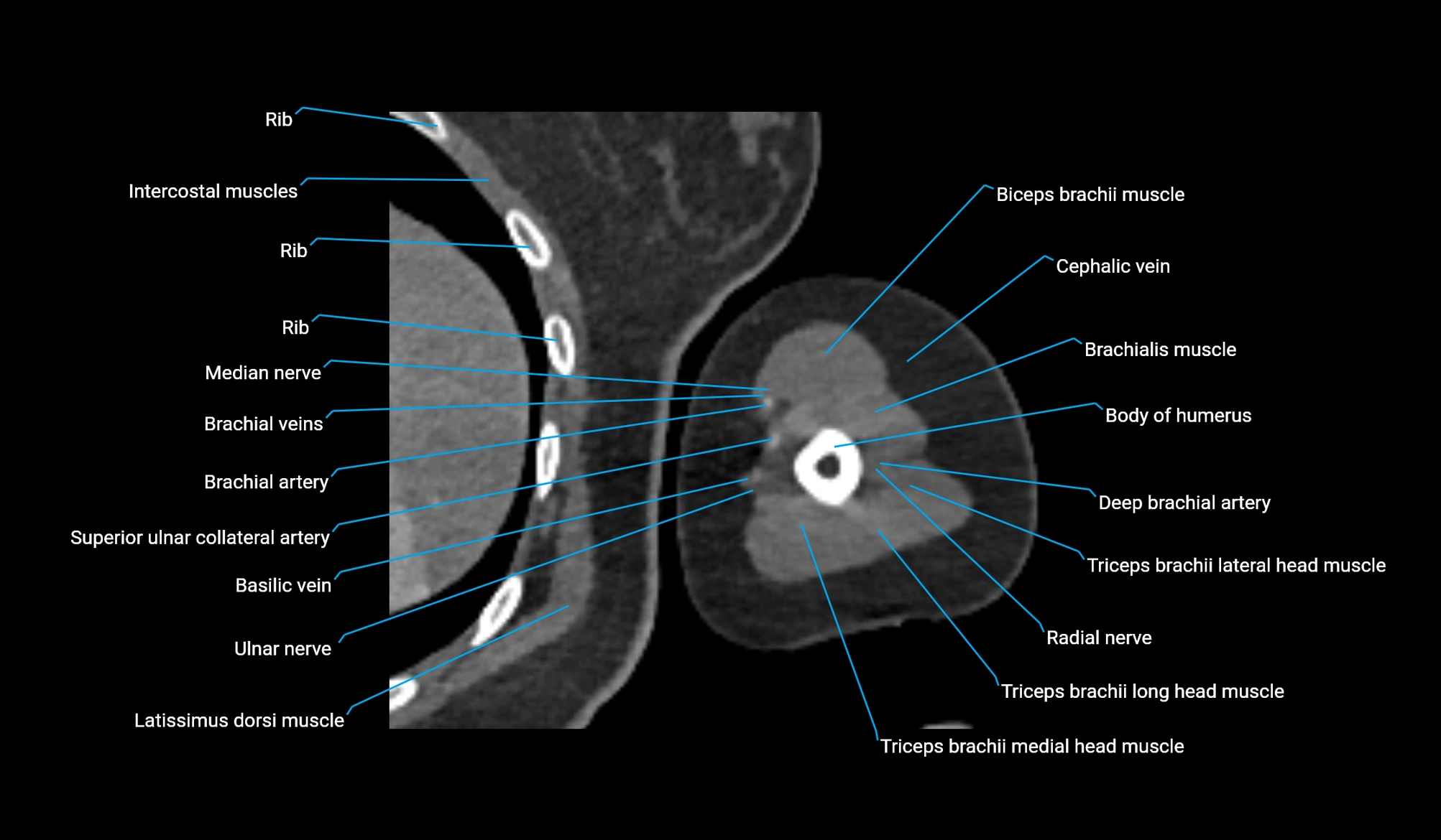 CT upper arm axial  cross sectional anatomy labelled radiology image -00270.webp